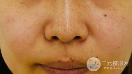 誰(shuí)做過(guò)彩光嫩膚有果嗎 誰(shuí)做過(guò)彩光嫩膚有果嗎