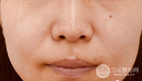 誰(shuí)做過(guò)彩光嫩膚有果嗎 誰(shuí)做過(guò)彩光嫩膚有果嗎