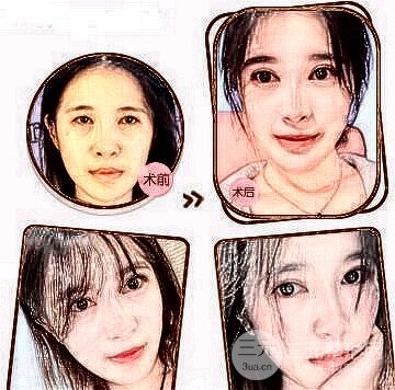 全割雙眼皮案例