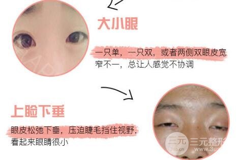 定點(diǎn)雙眼皮價(jià)格貴嗎 多少錢