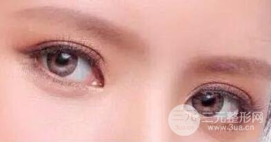 單眼皮割雙眼皮好還是埋線好？哪個好一點？