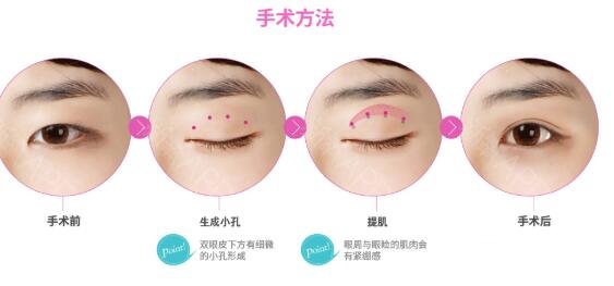 什么是切開雙眼皮?