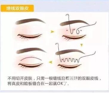 埋線雙眼皮手術(shù)法