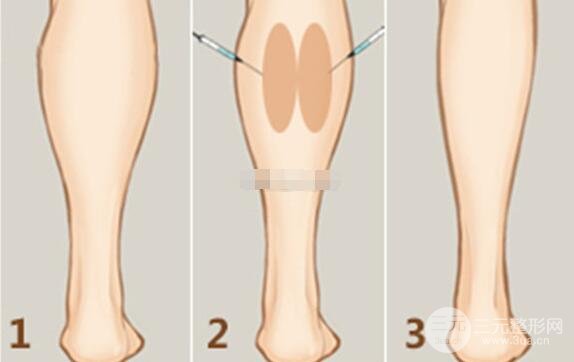 ****瘦腿價(jià)格貴不貴？一般多少錢？