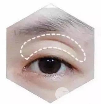 眼窩填充的方式