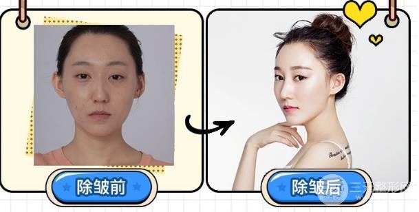 激光去除抬頭紋很有果