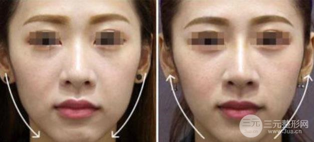 熱拉提美容果原理