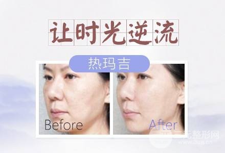 #術(shù)前了解#熱瑪吉除皺能維持多久？果好不好呢？