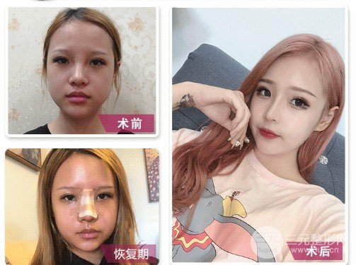 假體硅膠隆鼻可以放一輩子嗎