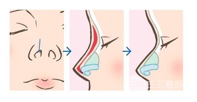 假體硅膠隆鼻可以放一輩子嗎