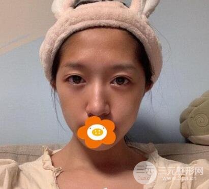 手術(shù)之前：