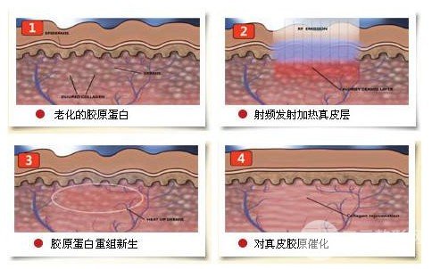 激光緩解黑眼圈有沒(méi)有副作用