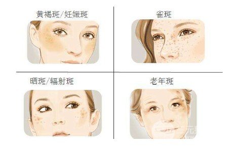 激光可以去除黃褐斑嗎
