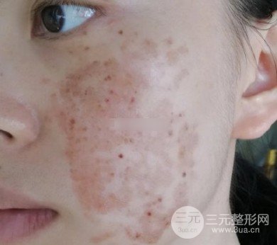 激光可以去除黃褐斑嗎