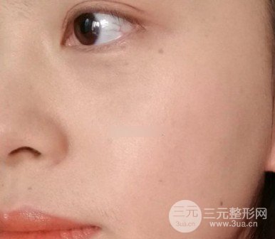 激光可以去除黃褐斑嗎