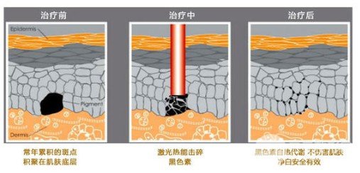 激光去黃褐斑需要做幾次