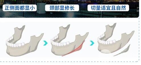 磨下頜角手術(shù)案例合集，磨骨手術(shù)科普~