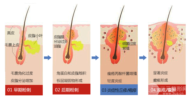 水楊酸祛痘的原理