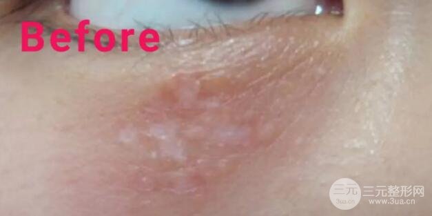 大家可以直觀的看到脂肪粒被祛除的過程