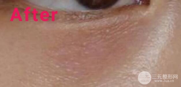 大家可以直觀的看到脂肪粒被祛除的過程