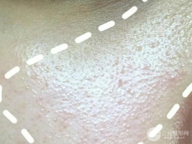 脂肪粒的自白：停用眼霜真的有用嗎？