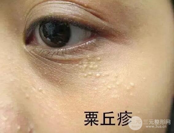 脂肪粒真的是因為護膚品過剩導(dǎo)致的嗎?