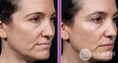 熱瑪吉全臉部?jī)r(jià)格表