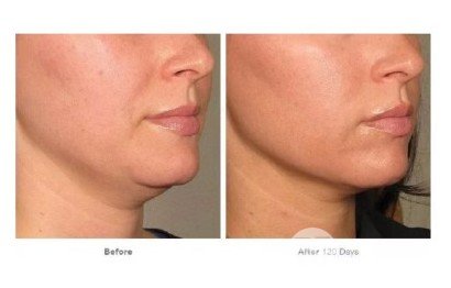 做完熱瑪吉注意事項