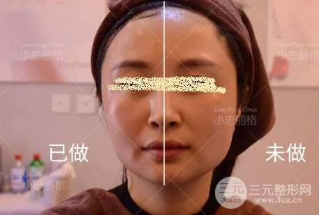 做完熱瑪吉注意事項