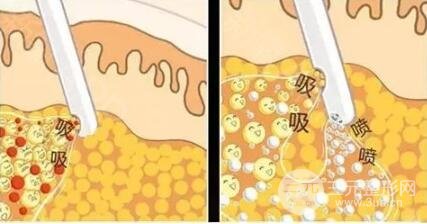 吸脂減肥價格是多少?