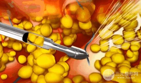 外科吸脂術的原理