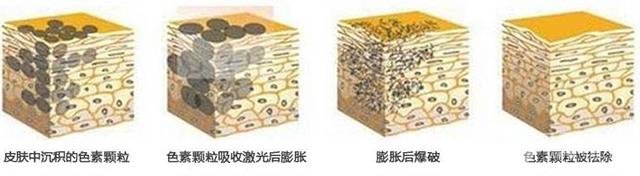 光子嫩膚建議頻率