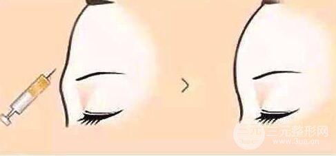 自體脂肪填充額頭