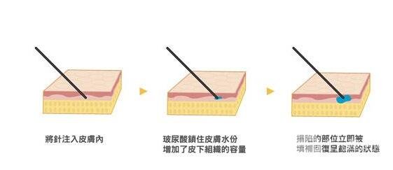 透明質(zhì)酸豐額頭