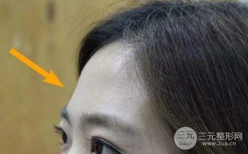 額頭填充適合人群