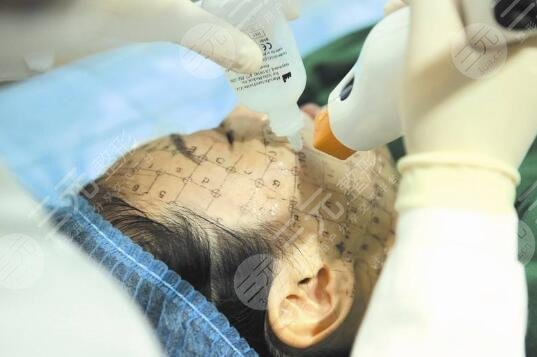 熱瑪吉緊膚除皺保持幾年?