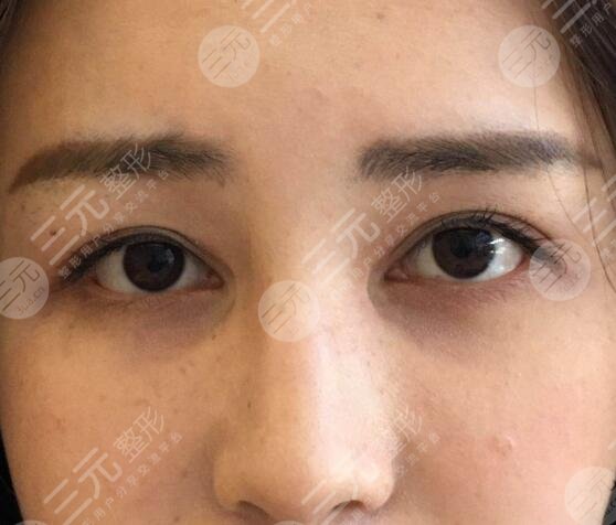 曹仁昌修復(fù)內(nèi)眼角案例前