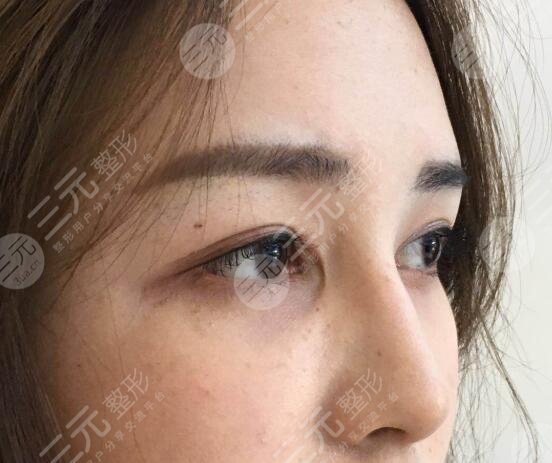 曹仁昌修復(fù)內(nèi)眼角案例