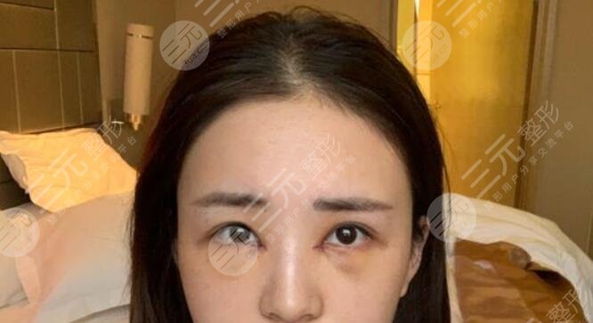 曹仁昌修復(fù)內(nèi)眼角案例后一周