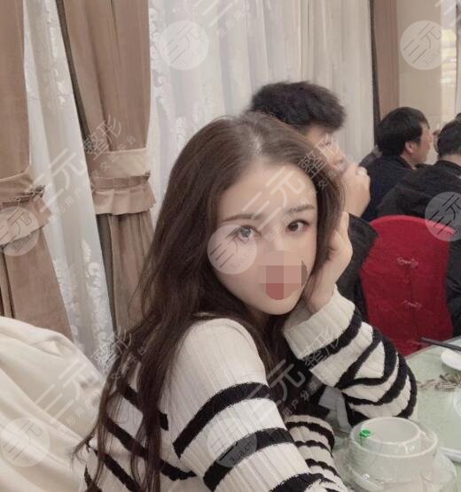 曹仁昌修復(fù)內(nèi)眼角案例后3周