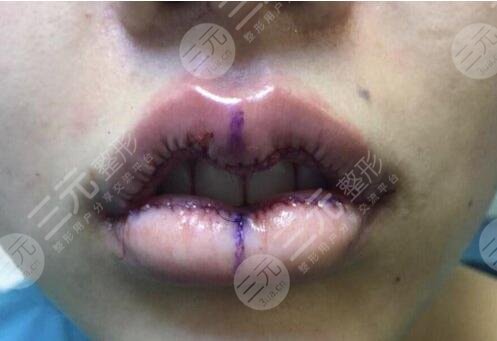 厚唇改薄整形手術(shù)圖片
