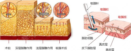 【科普】疼痛感較輕吸脂是怎么做的？吸脂手術(shù)有哪些方法呢？
