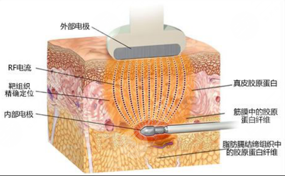 【科普】疼痛感較輕吸脂是怎么做的？吸脂手術(shù)有哪些方法呢？