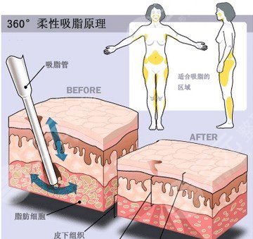 【科普】疼痛感較輕吸脂是怎么做的？吸脂手術(shù)有哪些方法呢？