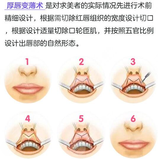 厚唇改薄手術(shù)降低風(fēng)險嗎