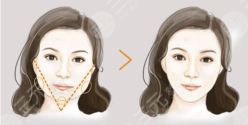 注射瘦臉是打50還是100劑量？每個人面部情況不一樣，可別在稀里糊涂啦！