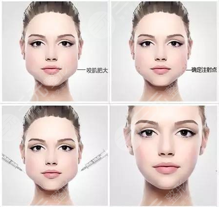 注射瘦臉是打50還是100劑量？每個人面部情況不一樣，可別在稀里糊涂啦！