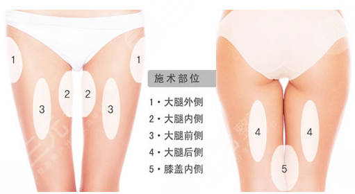 今天給大家科普一下腿部吸脂的人后來都怎么樣了？
