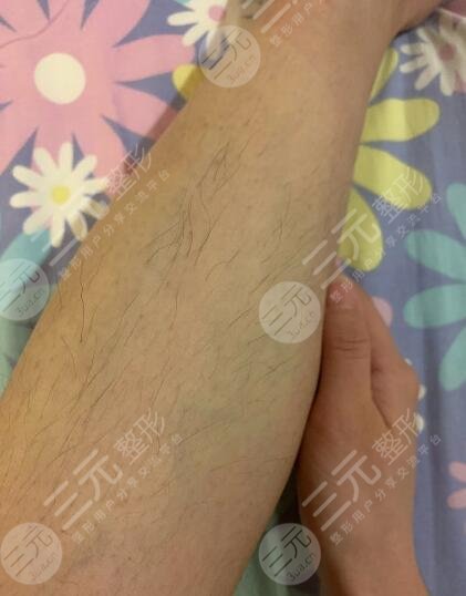 泰州市人民醫(yī)院脫毛價格貴嗎？如果你有嚴重汗毛煩惱一定不要錯過！