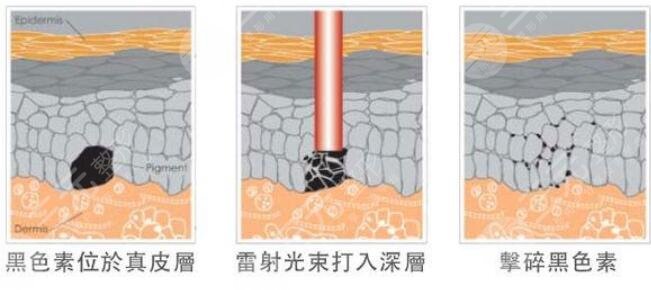 激光祛黃褐斑會越來越嚴重嗎